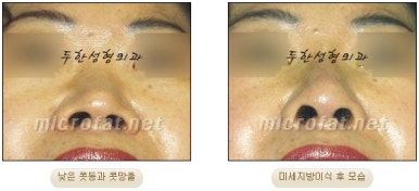 [Duhan Plastic Surgery Facial Fat Grafting] - [Fat Grafting Rhinoplasty] image 16