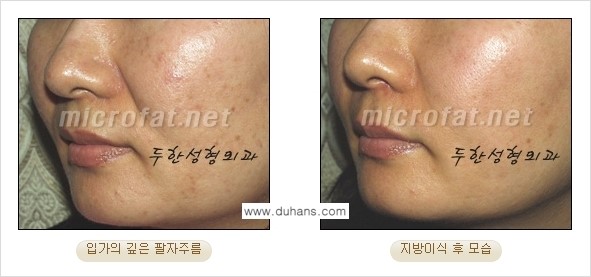 [두한성형외과의 경쟁력 있는 지방이식] - [입가주름, 팔자주름 미세지방이식 1.] 관련 이미지 7