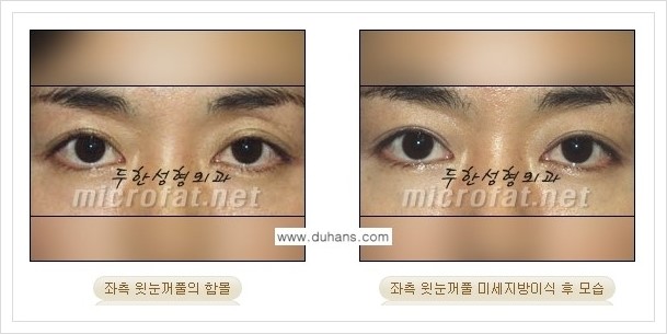 [두한성형외과의 경쟁력 미세지방이식] - [꺼진 눈꺼풀(윗눈꺼풀 함몰) 미세지방이식 안내] 관련 이미지 3