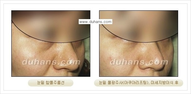 [두한성형외과 경쟁력 주름성형] - [미간주름, 눈가주름, 눈밑주름 제거 시술 안내] 관련 이미지 5
