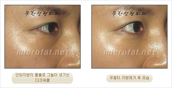 [두한성형외과 쌍커풀수술] - [눈성형 방법에 대한 자주하는 질문과 답변] 관련 이미지 190