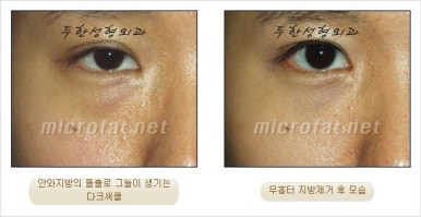 두한성형외과 눈밑수술 - 다크서클 수술 전후 관리 안내 관련 이미지 54