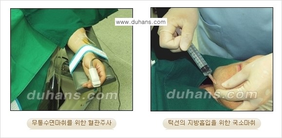 ​​​﻿[두한성형외과 경쟁력 간편지방흡입] - [볼살지방흡입, 턱선지방흡입 시술 과정의 안내] 관련 이미지 4