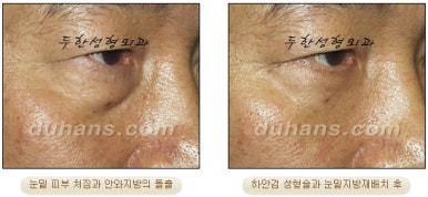 Blepharoplasty, Duhan Plastic Surgery - Upper and Lower Eyelids image 37