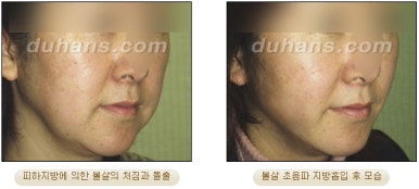 [두한성형외과 안전한 지방흡입] - [얼굴지방흡입] 관련 이미지 33