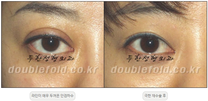[Double Eyelid Surgery, Duhan Plastic Surgery] - [Extreme Revision Eye Surgery to Correct a Damaged Line] image 17