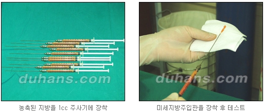 [두한성형외과 얼굴자가지방이식] - [지방이식 과정] 관련 이미지 15