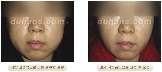 [두한성형외과 얼굴자가지방이식] - [볼살, 이마, 측두부] 관련 이미지 45