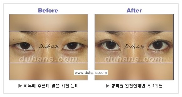 [두한성형외과 경쟁력 눈성형] - [퀵쌍꺼풀 수술 전후 정보 안내 ②] 관련 이미지 4