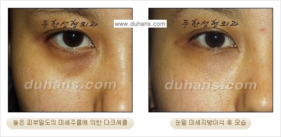 [두한성형외과 경쟁력 미세지방이식] - [다크써클 & 눈밑주름 미세지방이식 5.] 관련 이미지 7