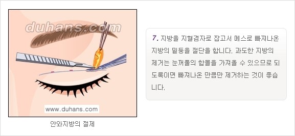 [두한성형외과 경쟁력 눈성형]- [최소 부기로 일상의로의 복귀가 가능한 아름다운 퀵쌍꺼풀(부분절개법) 수술] 관련 이미지 7
