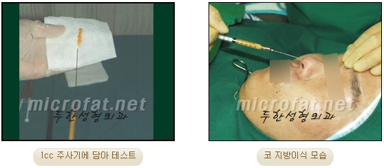 [Duhan Plastic Surgery Facial Fat Grafting] - [Fat Grafting Rhinoplasty] image 6