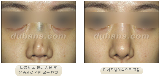 Naturally Beautifying! A Case Introduction of Nose Fat Grafting + Cheek & Chin Liposuction image 2