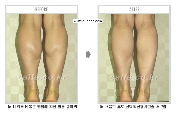 [두한성형외과 경쟁력 멀티종아리성형] - [종아리성형 전후 주의해야 할 내용 안내] 관련 이미지 10