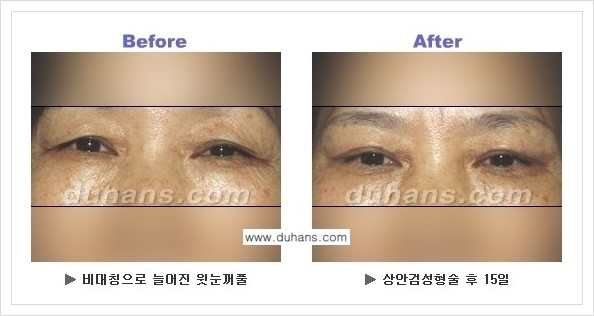 [두한성형외과 경쟁력 눈성형] - [상큼하고 환한 젊은 눈매 상안검성형(윗눈꺼풀 처짐) 안내] 관련 이미지 8