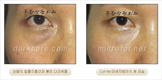 ​[두한성형외과 경쟁력 눈밑성형 리더] - [눈밑 다크써클의 증상, 원인, 종류, 치료방법 안내] 관련 이미지 21