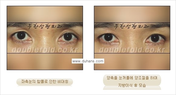 [두한성형외과 NO.1 눈성형] - [함몰된(꺼진) 눈꺼풀에서 쌍꺼풀 라인 교정 3.] 관련 이미지 5