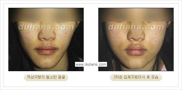 [두한성형외과 경쟁력 얼굴미세지방이식] - [볼살지방이식, 이마지방이식, 측두부지방이식 안내] 관련 이미지 10
