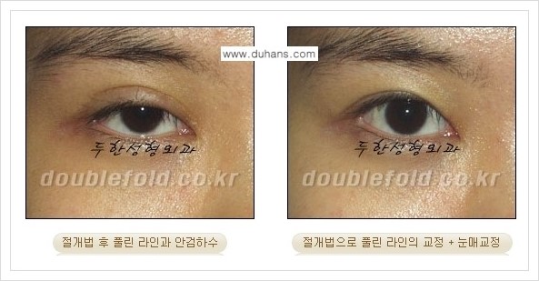 [두한성형외과 경쟁력 쌍꺼풀 재수술, 극한 눈재수술] - [풀린 쌍꺼풀 라인 교정수술 안내] 관련 이미지 4