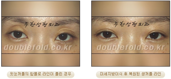 [Eye Reoperation Duhan Plastic Surgery] - [Guide to Double Eyelid Revision Surgery] image 61