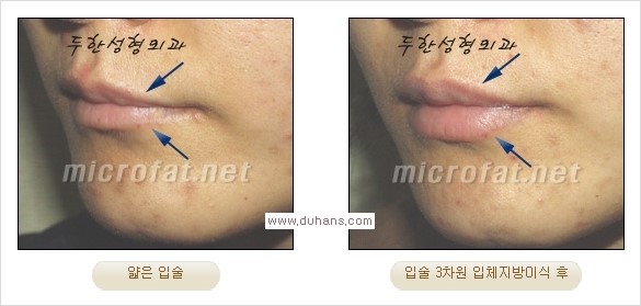 [두한성형외과 경쟁력 미세지방이식] - [입술 3차원 입체지방이식 안내 2.] 관련 이미지 7