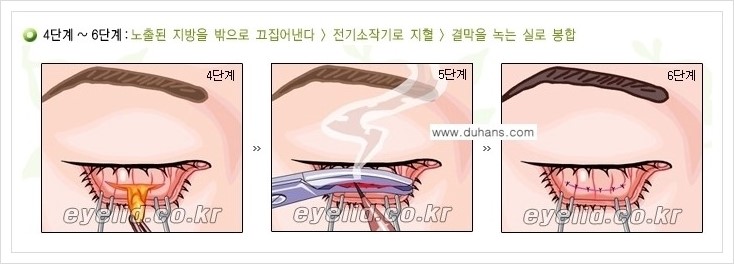 [두한성형외과 경쟁력 지방제거] - [윗눈꺼풀 지방제거, 아랫 눈꺼풀 지방제거  안내 2.] 관련 이미지 5