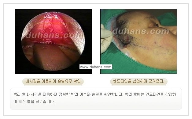 [두한성형외과 경쟁력 주름교정술] - [엔도타인 리프팅 안내 ②] 관련 이미지 6