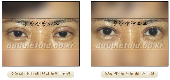 [두한성형외과 쌍커풀수술] - [눈성형 방법에 대한 자주하는 질문과 답변] 관련 이미지 36