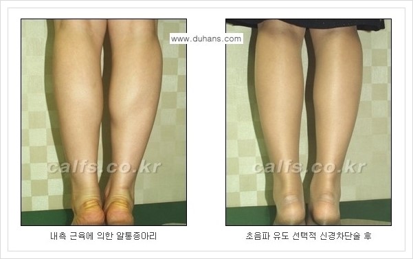 [두한성형외과 경쟁력 멀티종아리성형] - [나에게 맞는 종아리성형 방법의 종류 안내 2.] 관련 이미지 5