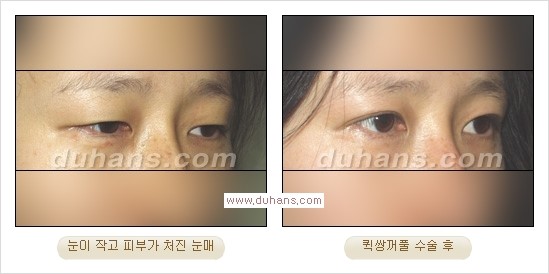 ​[두한성형외과 경쟁력 눈성형] - [자연스럽고 아름다운 쌍꺼풀의 기준] 관련 이미지 20