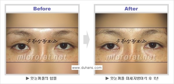 [두한성형외과 NO.1 눈성형] - [눈꺼풀 지방이식 관련 흔한 질문과 답변] 관련 이미지 5
