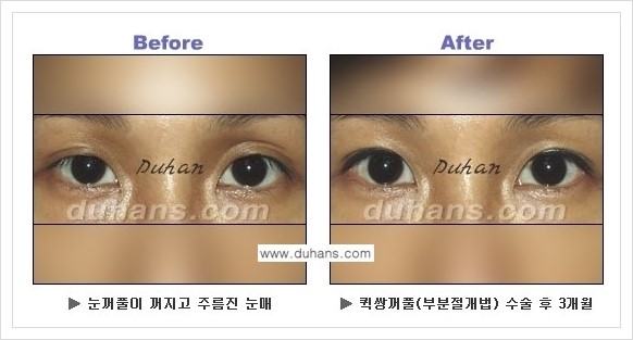 [두한성형외과 경쟁력 쌍꺼풀 재수술, 극한 재수술] - [퀵쌍꺼풀 안내] 관련 이미지 3