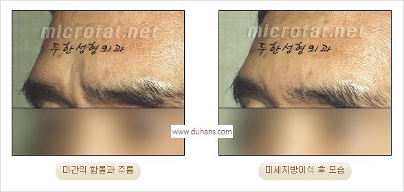 [두한성형외과 경쟁력 동안성형 리더] - ​[미간주름, 이마주름, 안검성형, 이마거상술, 눈썹거상술] 관련 이미지 21