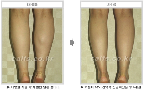 [종아리성형 두한성형외과] - [종아리수술에 대한 자주하는 질문과 답변 모음] 관련 이미지 73