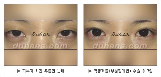 [두한성형외과 쌍커풀수술] - [눈성형 방법에 대한 자주하는 질문과 답변] 관련 이미지 120