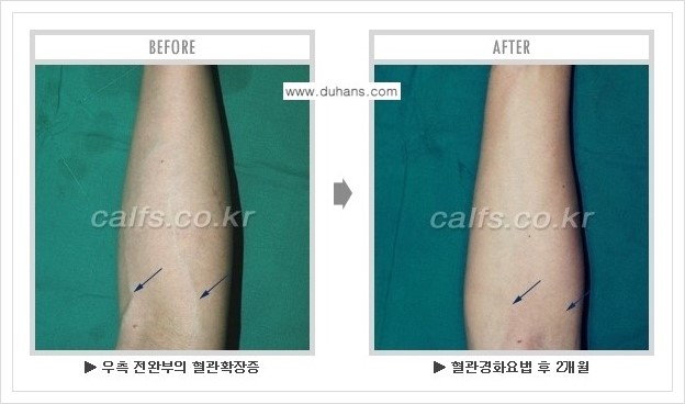 [두한성형외과 정맥류 치료] - [손, 팔 정맥확장증 사진자료 안내 ①] 관련 이미지 11