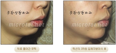 [Duhan Plastic Surgery Clinic Microgenia Correction] - [Chin Microfat Grafting] image 18