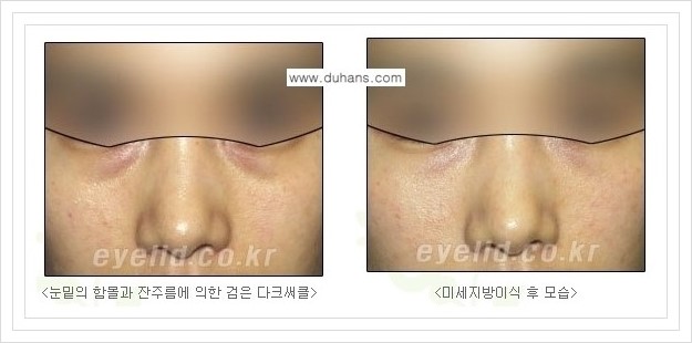[두한성형외과 경쟁력 눈밑성형] - [눈밑 미세지방이식으로 다크써클 치료] 관련 이미지 12