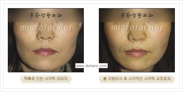 [두한성형외과 경쟁력 윤곽성형] - [볼, 볼살 지방이식] 관련 이미지 19