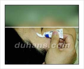 Duhan Plastic Surgery Wrinkle Improvement - Wrinkle Fillers, Juvederm image 4