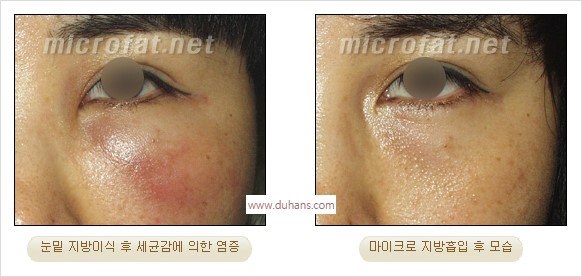 [두한성형외과 경쟁력 지방이식] - [지방이식 부작용 종류와 지방이식 부작용 교정 방법] 관련 이미지 34
