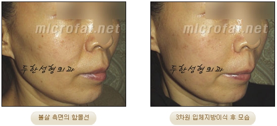 얼굴지방이식 두한성형외과 - 볼지방이식 관련 이미지 25