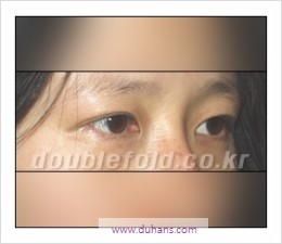 ⁠⁠[두한성형외과 경쟁력 쌍꺼풀 재수술] - [재수술 대상과 재수술의 문제점] 관련 이미지 33