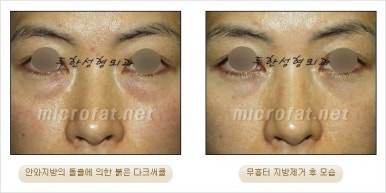 두한성형외과 눈밑수술 - 다크서클 수술 전후 관리 안내 관련 이미지 50
