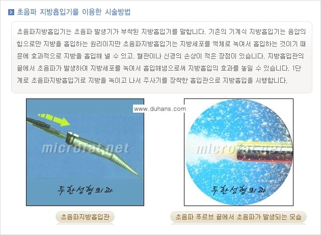 [두한성형외과 간편 지방흡입] - [복부(뱃살) 지방흡입 안내 ①] 관련 이미지 5