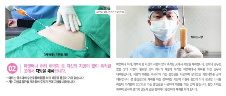 [두한성형외과 경쟁력 다크써클 치료] - [다크써클 + 눈위 지방이식 콤비 프로그램] 관련 이미지 7