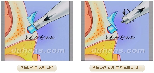 두한성형외과 안티에이징 리프팅 - 엔도타인 리프팅 관련 이미지 35