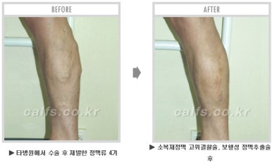 [종아리 두한성형외과] - [나에게 맞는 종아리시술] 관련 이미지 64