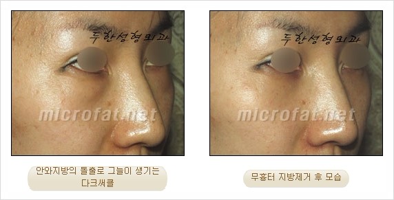 [두한성형외과 쌍커풀수술] - [눈성형 방법에 대한 자주하는 질문과 답변] 관련 이미지 163