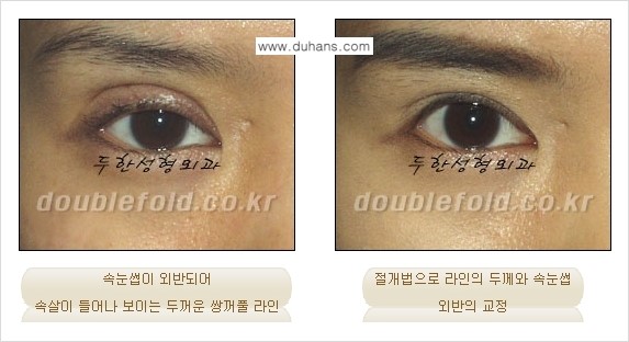 [두한성형외과 경쟁력 극한 눈(쌍꺼풀) 재수술] - [속눈썹 외반 교정] 관련 이미지 6